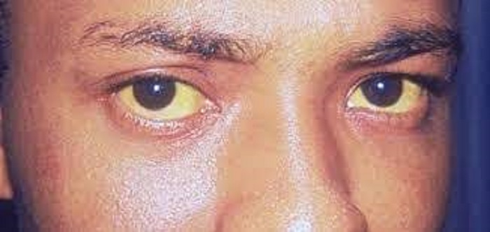 66 - لون عينيك يدل على إصابتك بهذا المرض الخطير.. قد يودي بحياتك