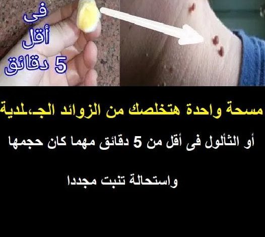 مسحة واحدة هتخلصك من الزوائد الجـ،ـلدية أو الثألول فى أقل من 5 دقائق مهما كان حجمها واستحالة تنبت مجددا 240796769 2078229389005501 8601957402052411335 n 526x470 - مسحة واحدة هتخلصك من الزوائد الجـ،ـلدية أو الثألول فى أقل من 5 دقائق مهما كان حجمها واستحالة تنبت مجددا