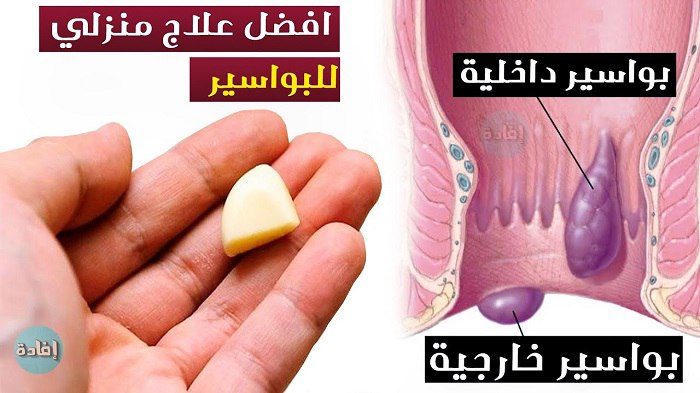 بشرى عظيمة..أقوى وصفة علاج البواسير طبيعيا وفي يوم واحد بأمان تام وعن تجربة 350827281 181868077842430 7959511496348741270 n - بشرى عظيمة..أقوى وصفة علاج البواسير طبيعيا وفي يوم واحد بأمان تام وعن تجربة